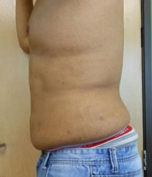 Abdomen Before & After Gallery - Patient 51821756 - Image 4
