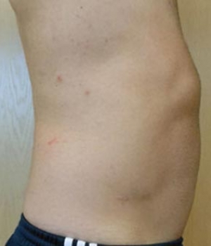 Abdomen Before & After Gallery - Patient 51821757 - Image 4