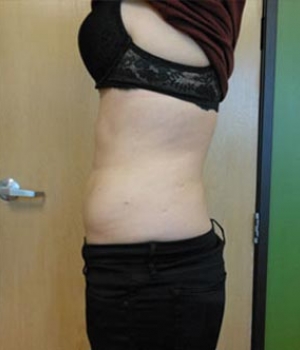 Abdomen Before & After Gallery - Patient 51821758 - Image 2