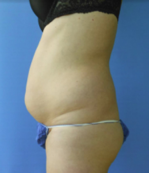 Abdomen Before & After Gallery - Patient 51821760 - Image 1