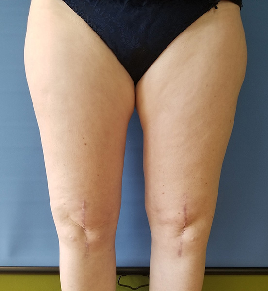 Inner Thigh Before & After Gallery - Patient 57609324 - Image 2