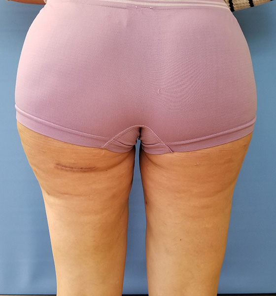 Inner Thigh Before & After Gallery - Patient 57609327 - Image 2