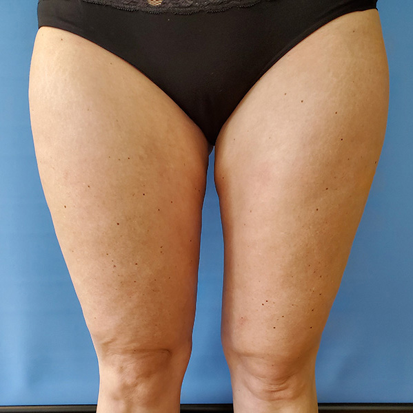 Inner Thigh Before & After Gallery - Patient 57609341 - Image 2