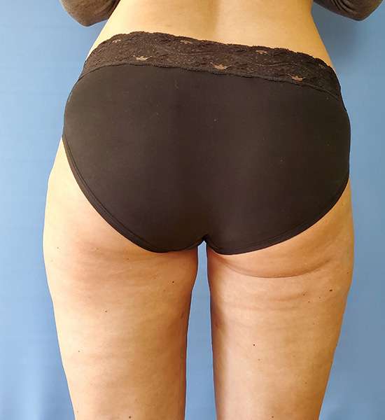 Inner Thigh Before & After Gallery - Patient 57609341 - Image 4