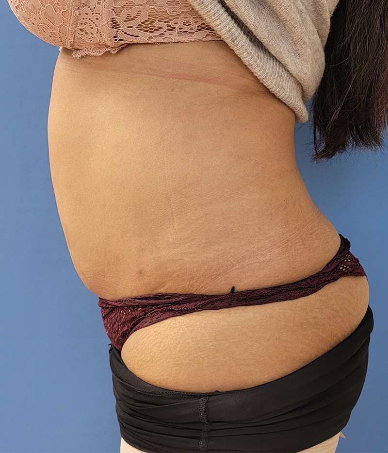 Abdomen Before & After Gallery - Patient 95447444 - Image 2