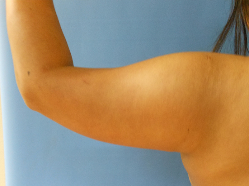 Arms Before & After Gallery - Patient 95447446 - Image 3