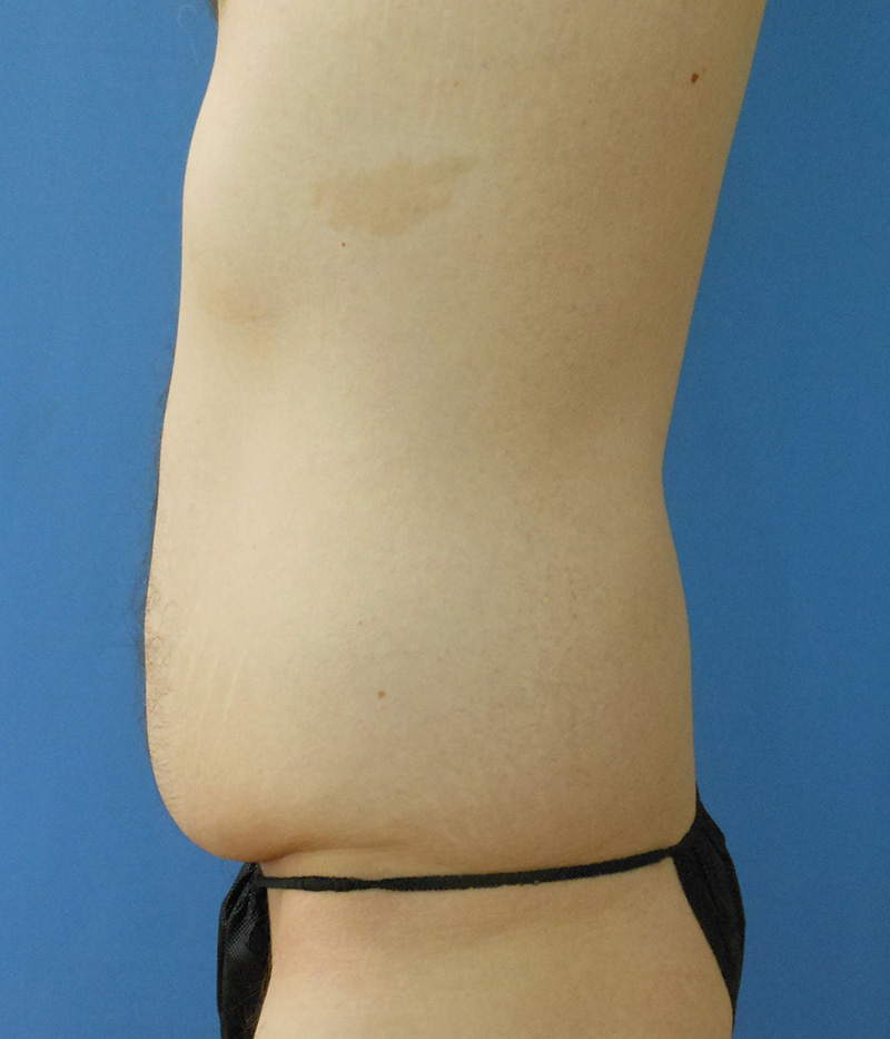 Abdomen Before & After Gallery - Patient 133503125 - Image 1