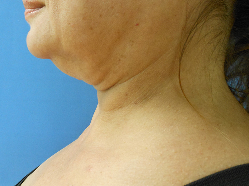 Neck Before & After Gallery - Patient 160772412 - Image 1