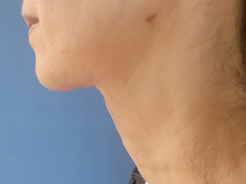 Neck Before & After Gallery - Patient 185847524 - Image 2