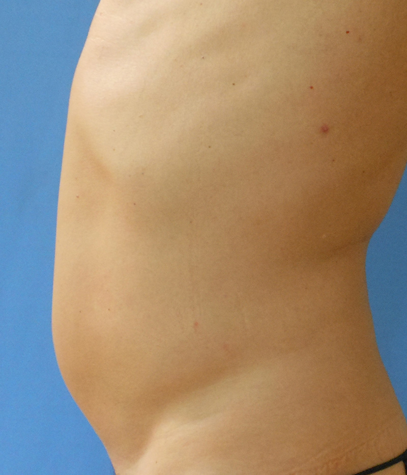 Abdomen Before & After Gallery - Patient 150344 - Image 1