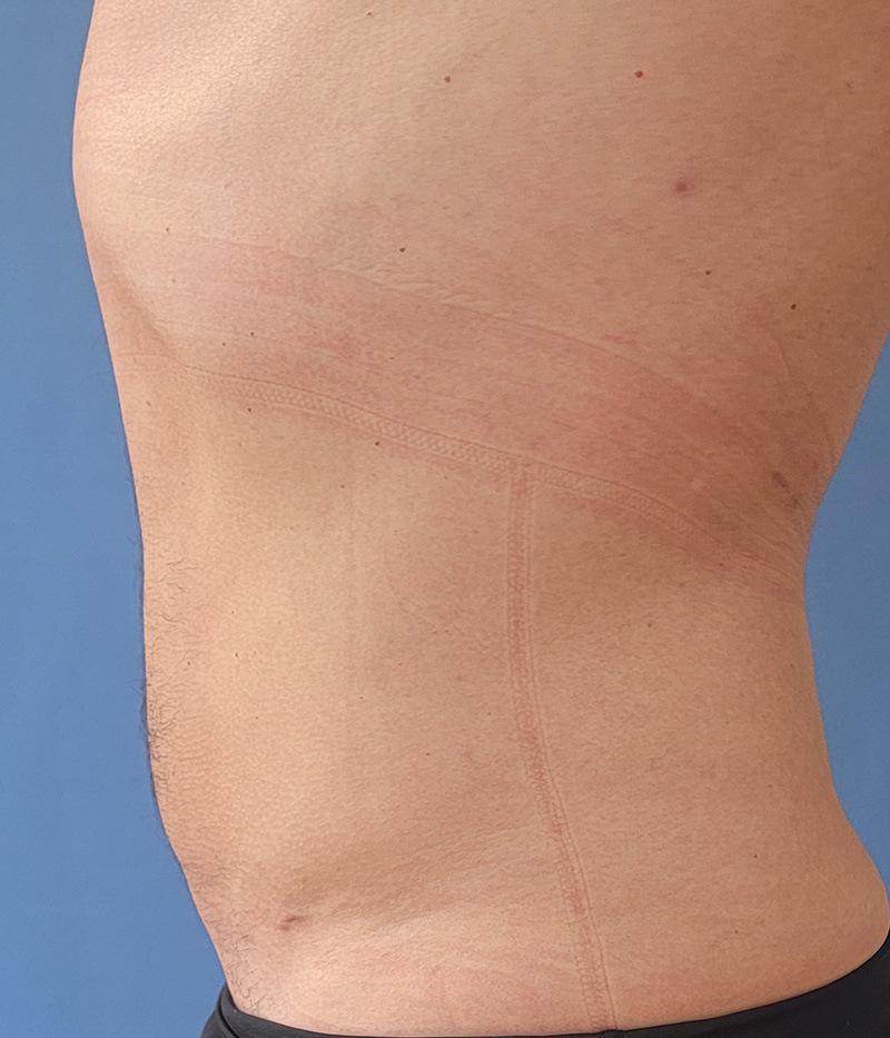 Abdomen Before & After Gallery - Patient 150344 - Image 2