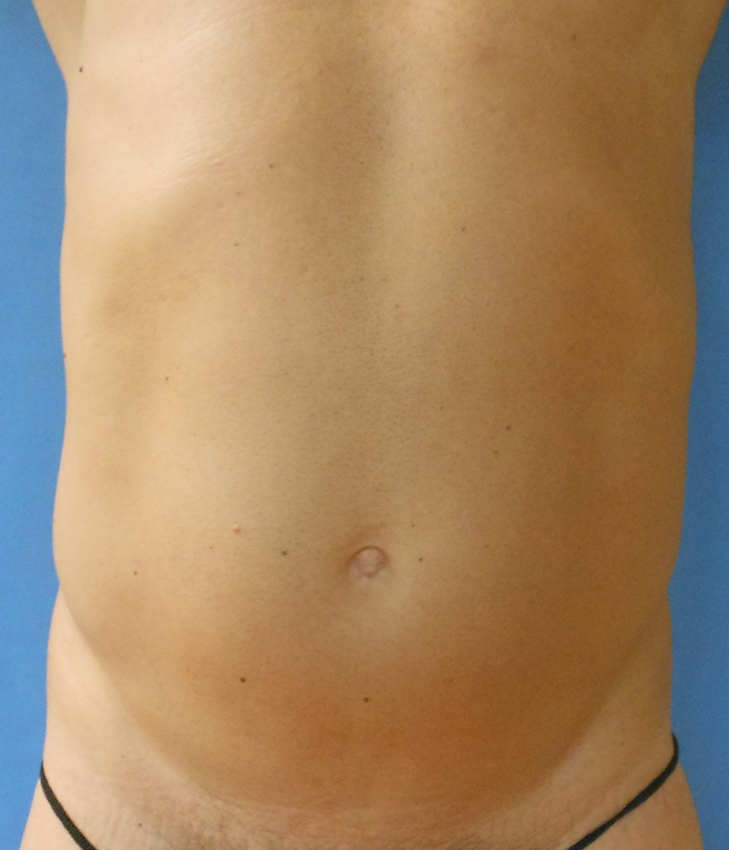 Abdomen Before & After Gallery - Patient 150344 - Image 3