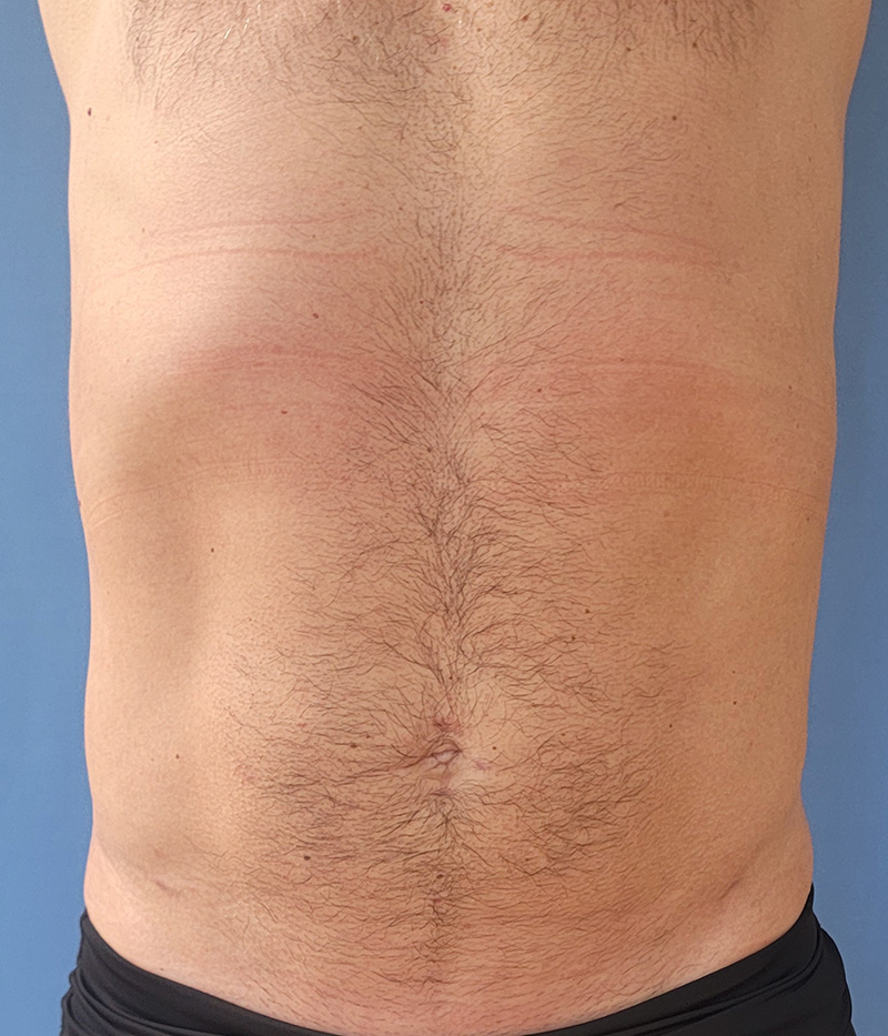 Abdomen Before & After Gallery - Patient 150344 - Image 4