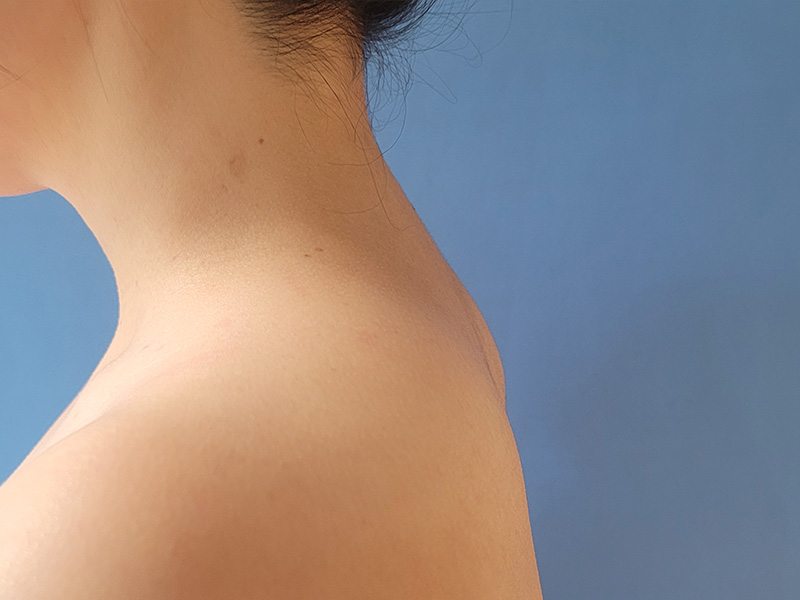 Buffalo Hump Before & After Gallery - Patient 238368 - Image 2