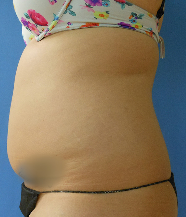 Side view of a torso in a bikini, with a noticeable belly and stretch marks