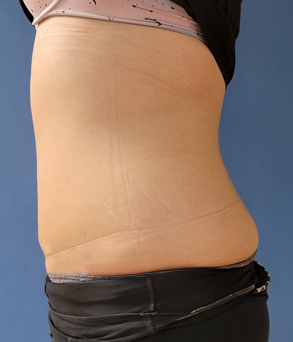 Side view of a torso showing skin and a visible garment line