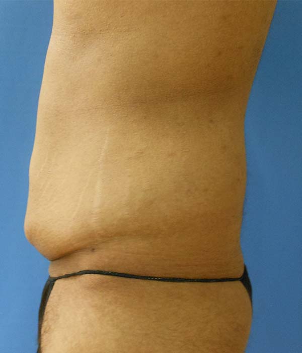 Side view of a torso showing skin and fat around the waist