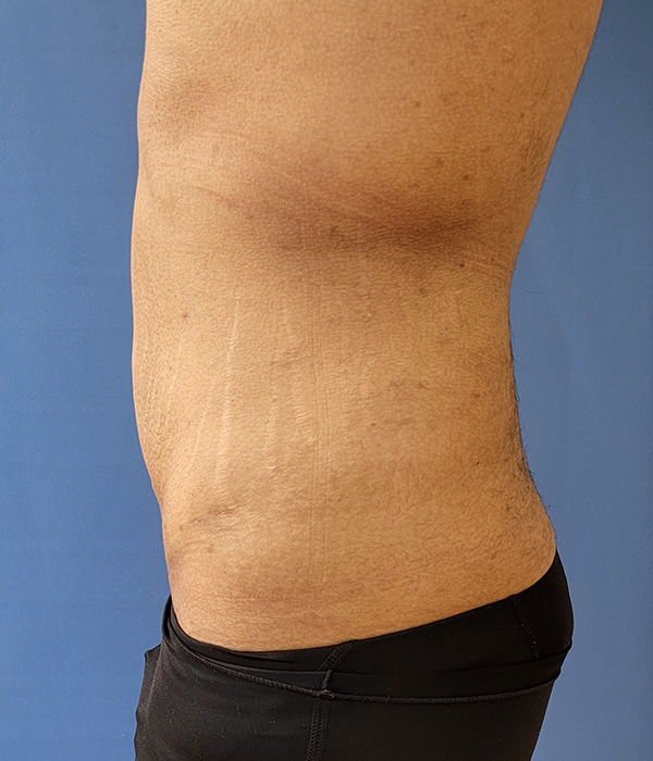 Side view of a torso showing skin and stretch marks against a blue background