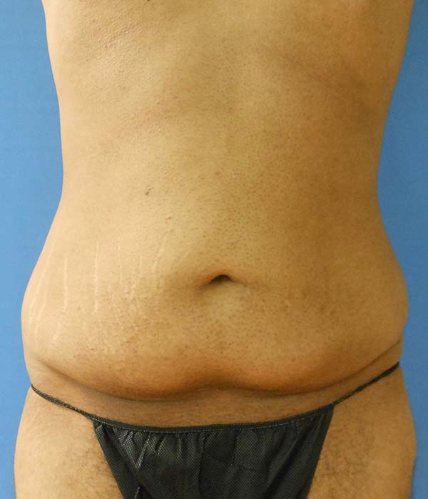 Image of the back of a person wearing black swimwear, showing skin texture and stretch marks
