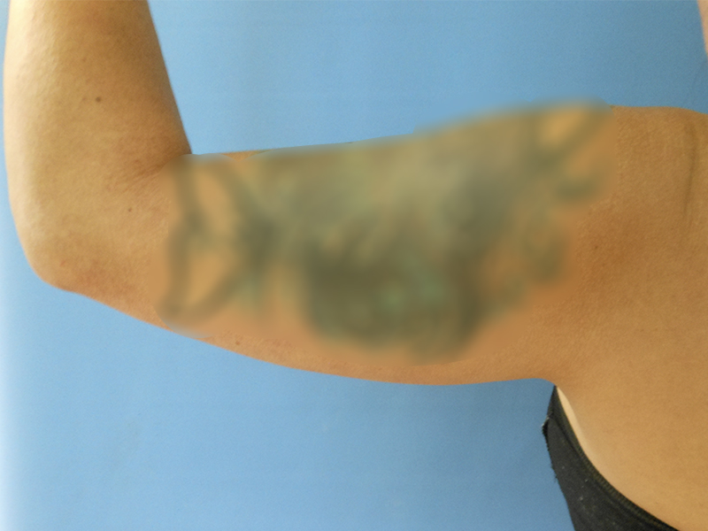 A close-up of a person's arm with a blurred tattoo on the upper arm, against a blue background