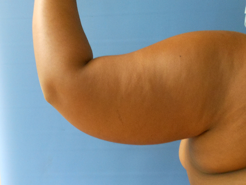 A close-up of a raised arm showing the elbow and inner arm against a blue background
