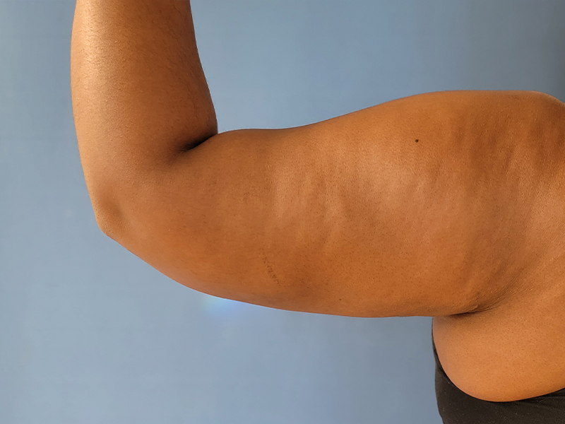 A close-up of a person's arm showing skin tone and muscle definition