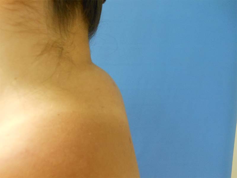 Close-up of a shoulder and neck against a blue background