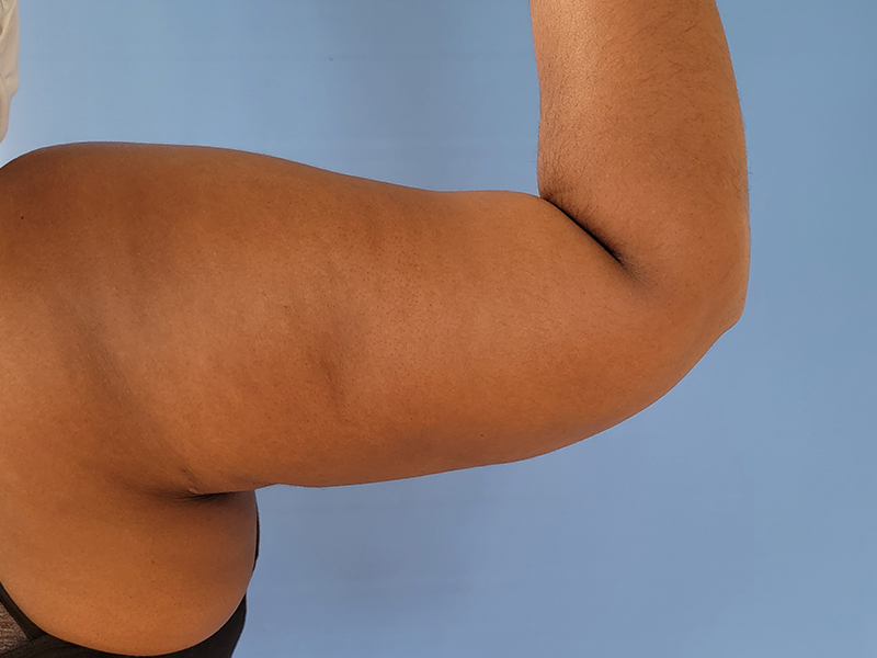 A close-up of a flexed arm against a light blue background