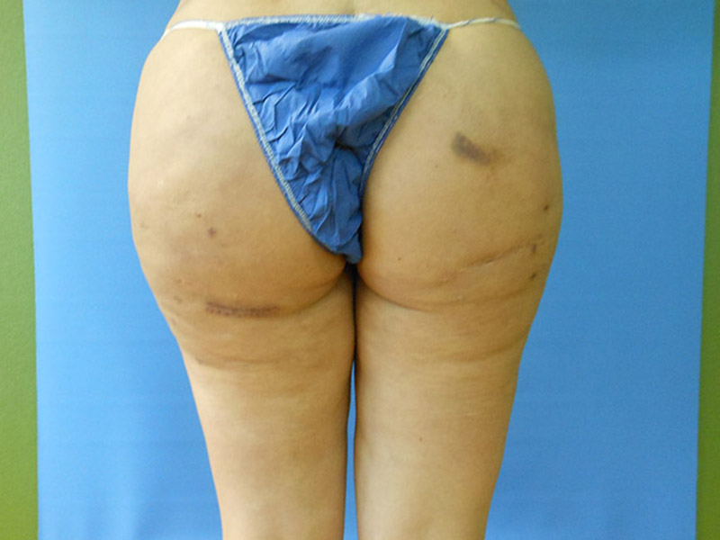 Rear view of a person wearing blue underwear, showing skin and some bruising