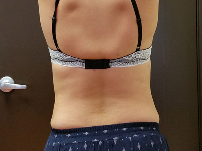 Person's upper back with a black and lace bra strap, wearing blue patterned shorts