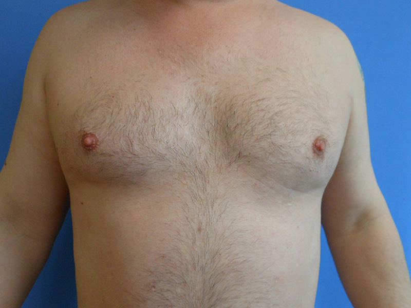 Bare male chest with hair, facing forward, against a blue background