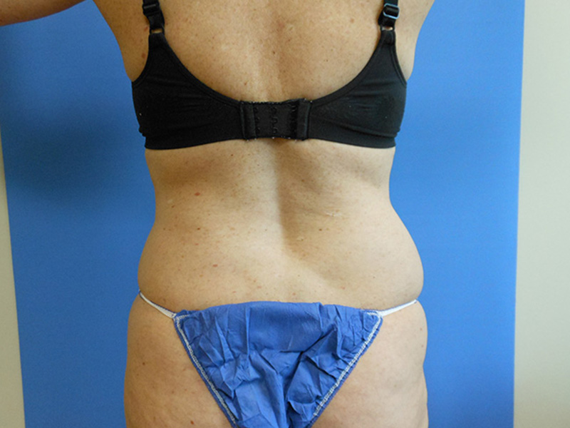 Back view of a person wearing a black bra and blue bikini bottom against a blue background