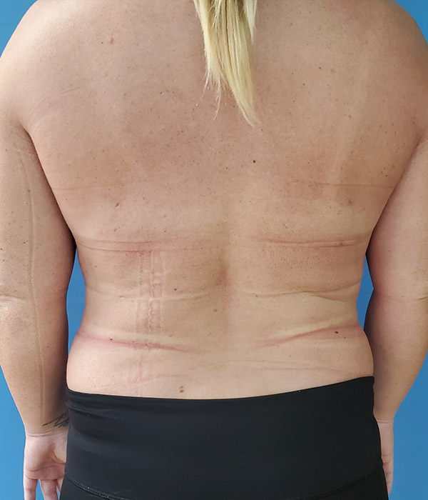 View of a person's back with skin markings and a blue background