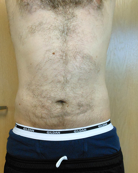 A person's torso with visible body hair, wearing blue shorts and a white waistband