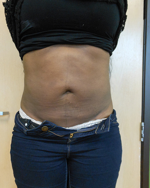 View of a person's abdomen, wearing a black top and blue jeans. Skin shows stretch marks