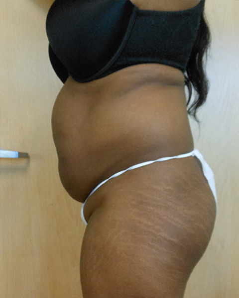 Side view of a woman wearing a black bra and white underwear, showing stretch marks