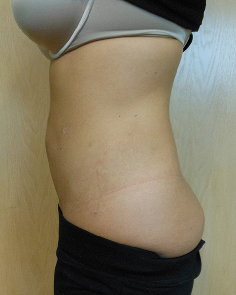 Side view of a person's torso showing skin and a faint line on the waist