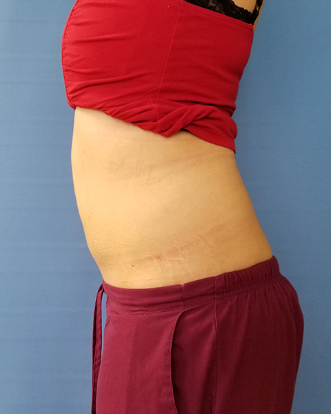 Side view of a person's midsection showing skin with stretch marks and a red top