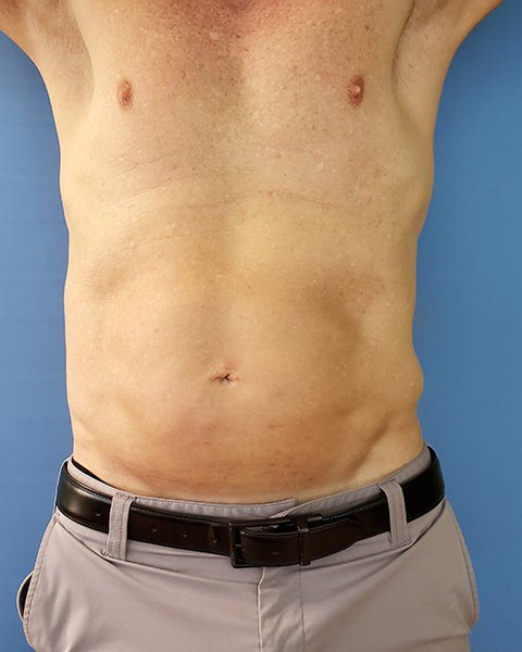 Bare torso of a person with a light background, showing a midsection and two nipples