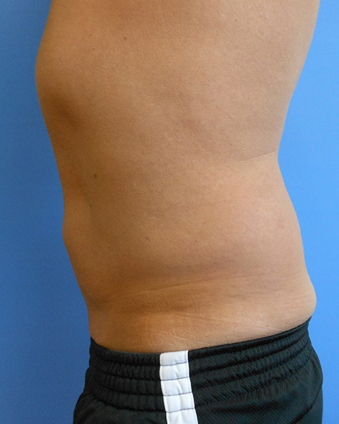 Side view of a person's torso, with a smooth skin surface and wearing black shorts