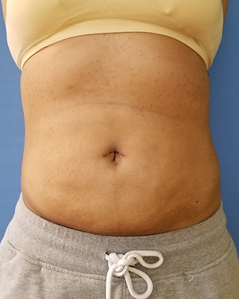 A person’s abdomen wearing a light top and gray sweatpants, with visible skin texture