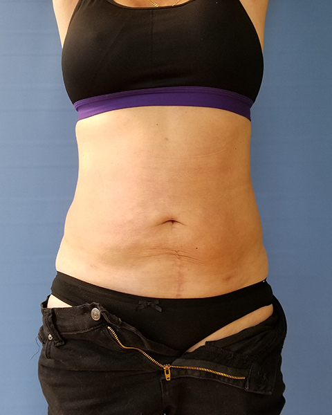 Image of a person's torso with a visible abdominal area and dark pants unzipped