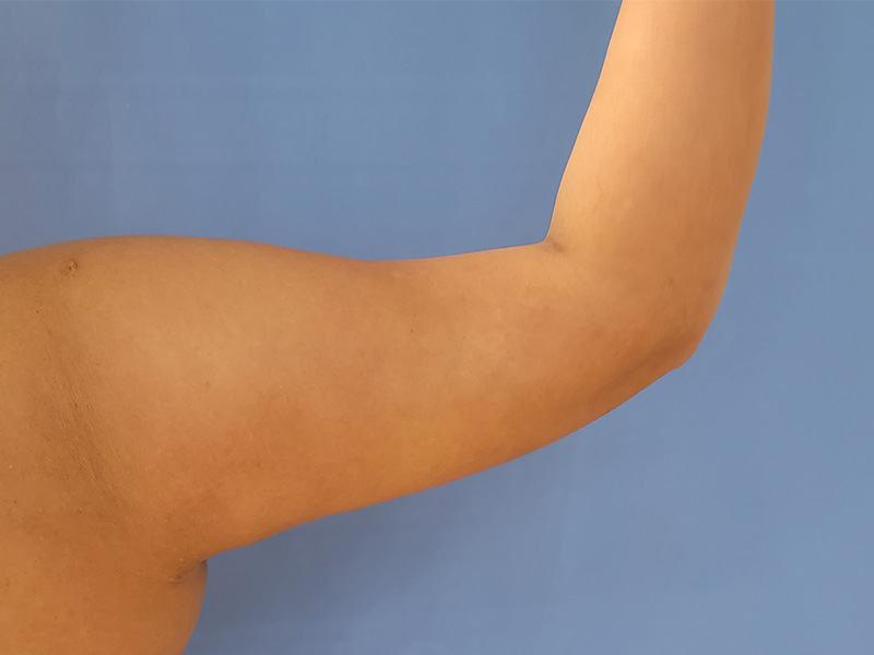 A close-up of a bare arm against a blue background, showing the elbow and upper arm