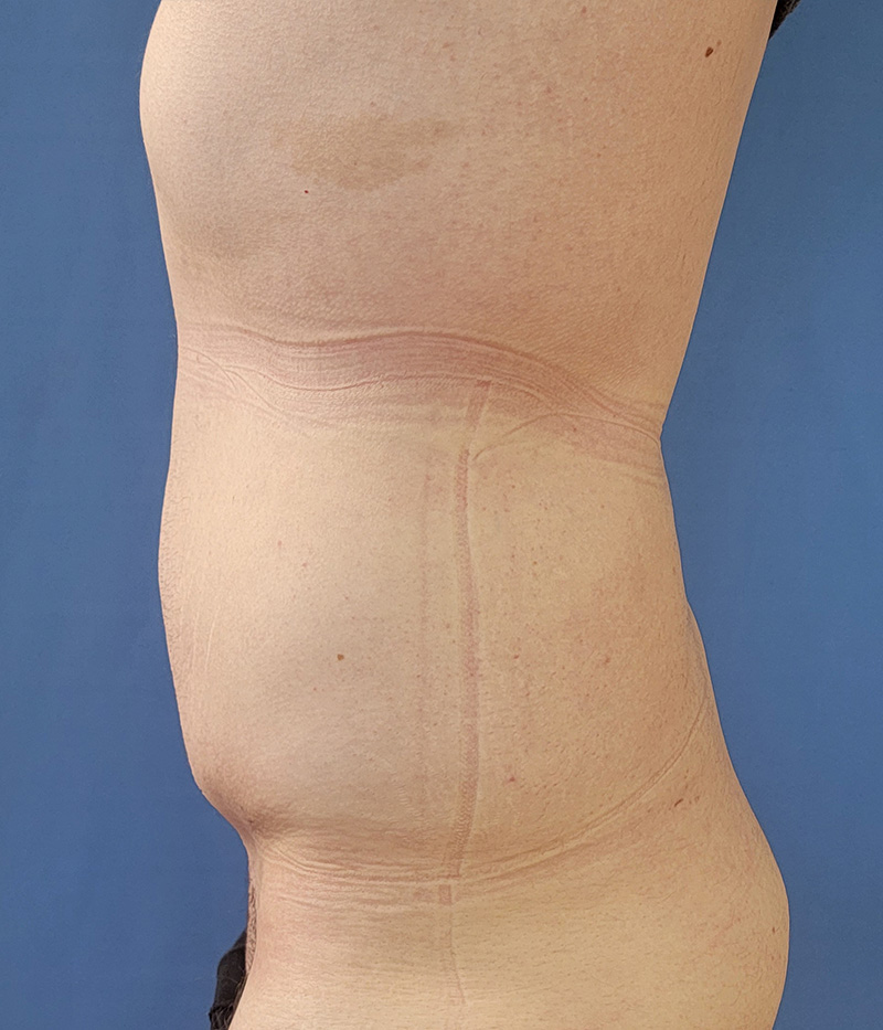 Profile view of a torso showing visible skin marks along the side