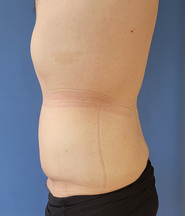 Side view of a torso with a visible line marked on the skin. Background is blue