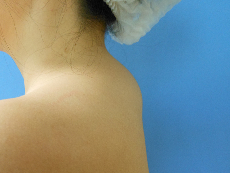 Side view of a person's neck and shoulder against a blue background