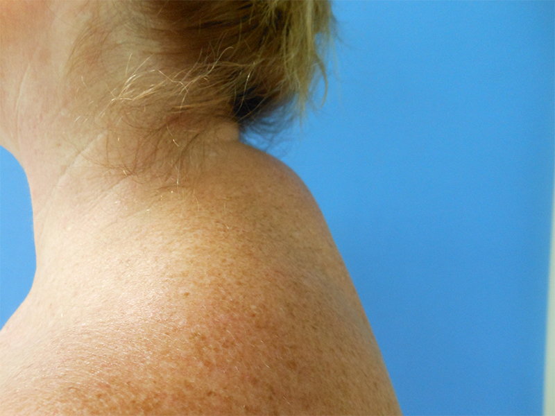 Side view of a woman’s neck and shoulder against a blue background