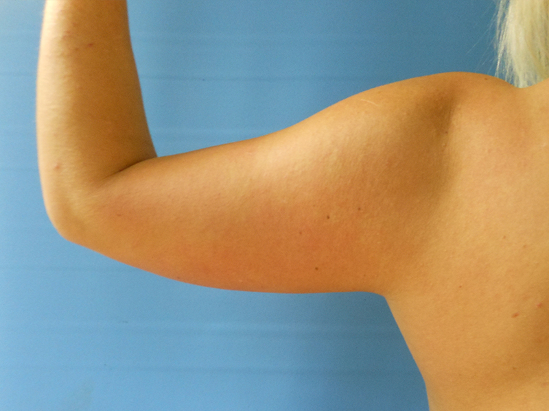 A close-up of a bare upper arm with a flexed muscle against a blue background