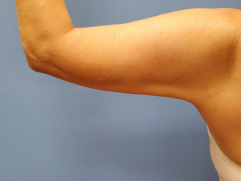 A close-up of a bare arm with a visible elbow and light skin tone against a blue background