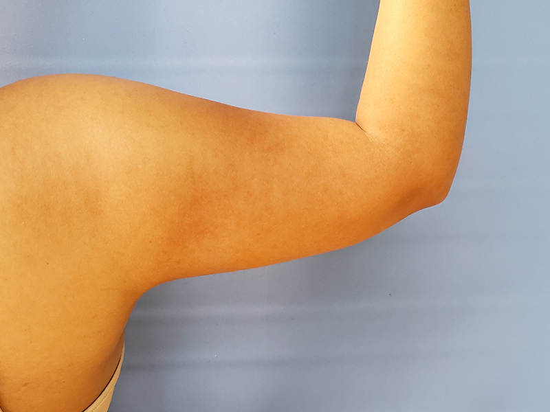 A close-up of a raised arm showing the bicep against a light blue background